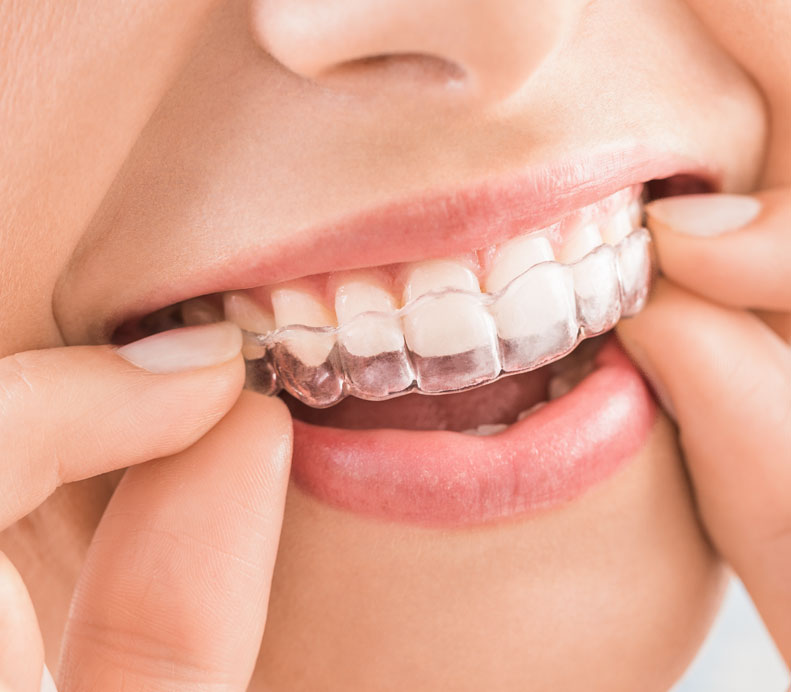 Eine Frau setzt eine Aligner Schiene in den Mund ein